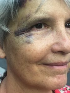 My bruised face/black eye